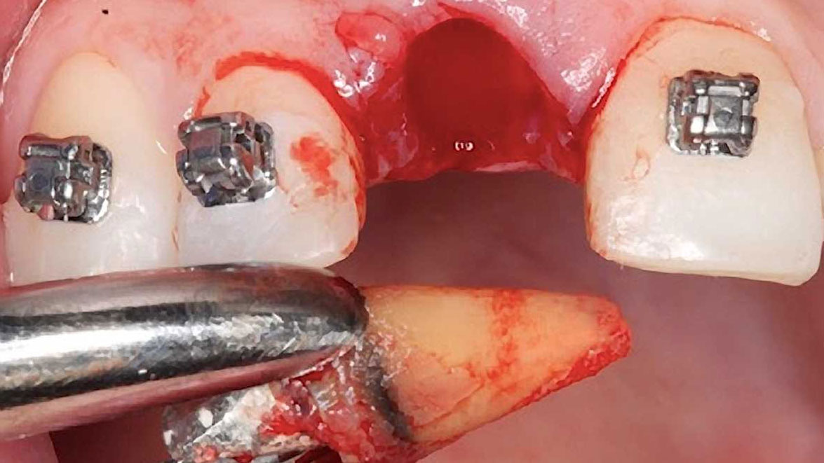 como-lograr-cirugias-exitosas-y-evitar-complicaciones